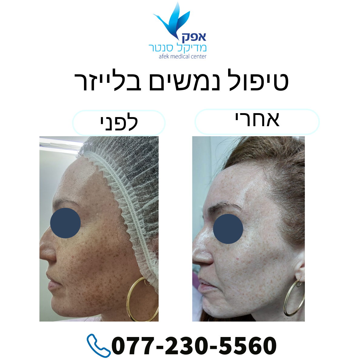 טיפול בפיגמנטציה